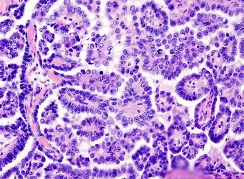 CancerRes：新研究发现帮助清除癌症干细胞的新靶标